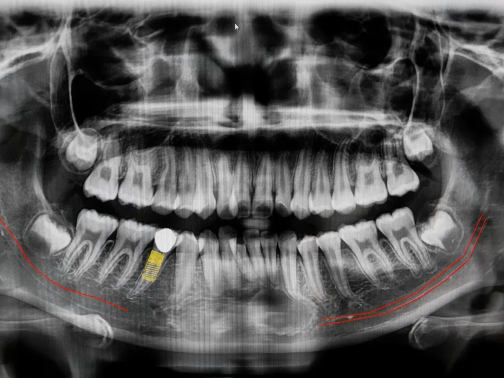 digital x-ray at Smile Now Boise Dentures & Implants Boise