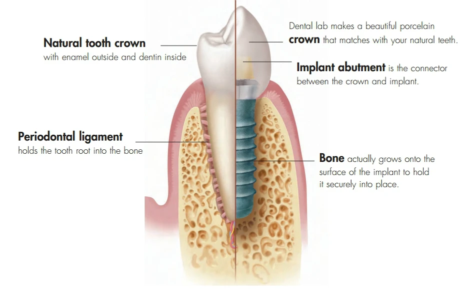 graphic of a natural tooth versus a dental implant