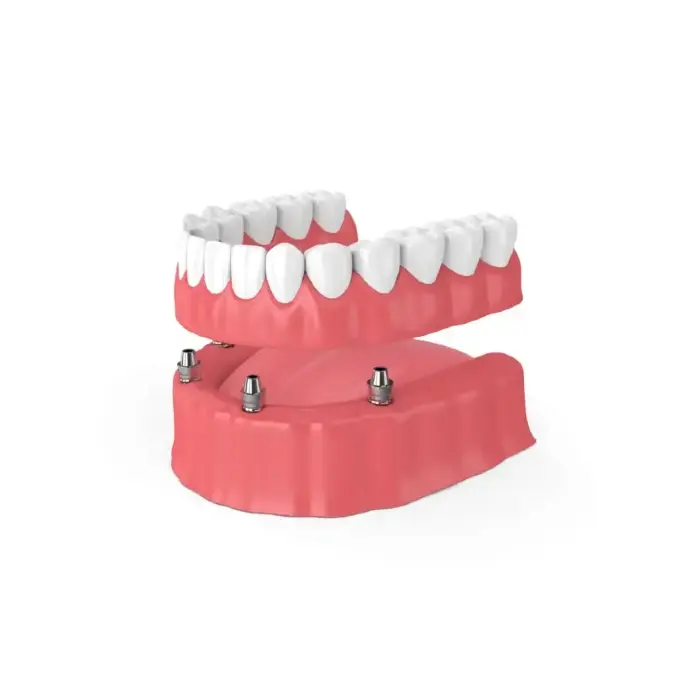 snap in implant dentures | overdentures model