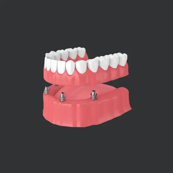 model of snap-in implant dentures