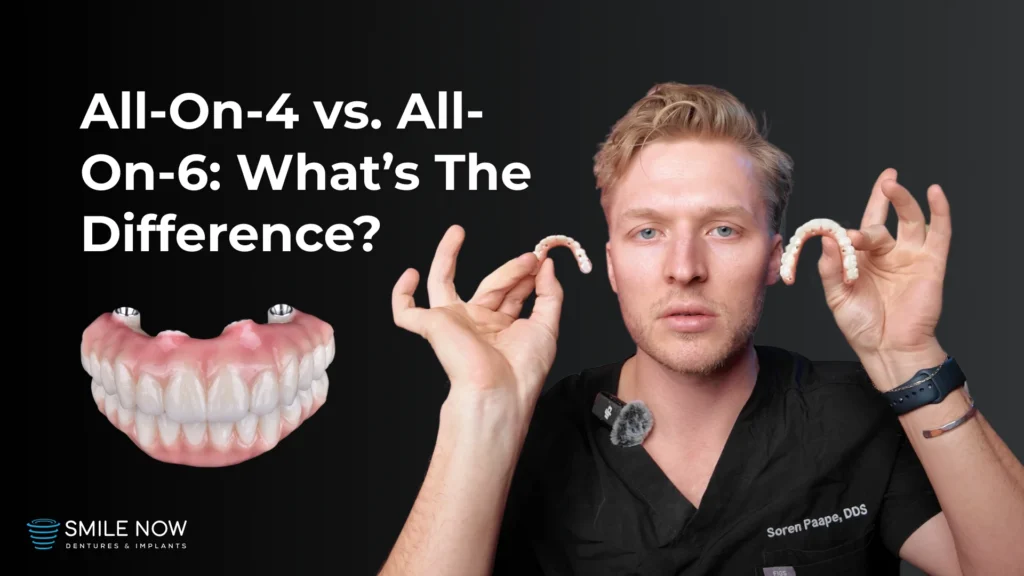 Video thumbnail for all on 4 vs all on 6 dental implants