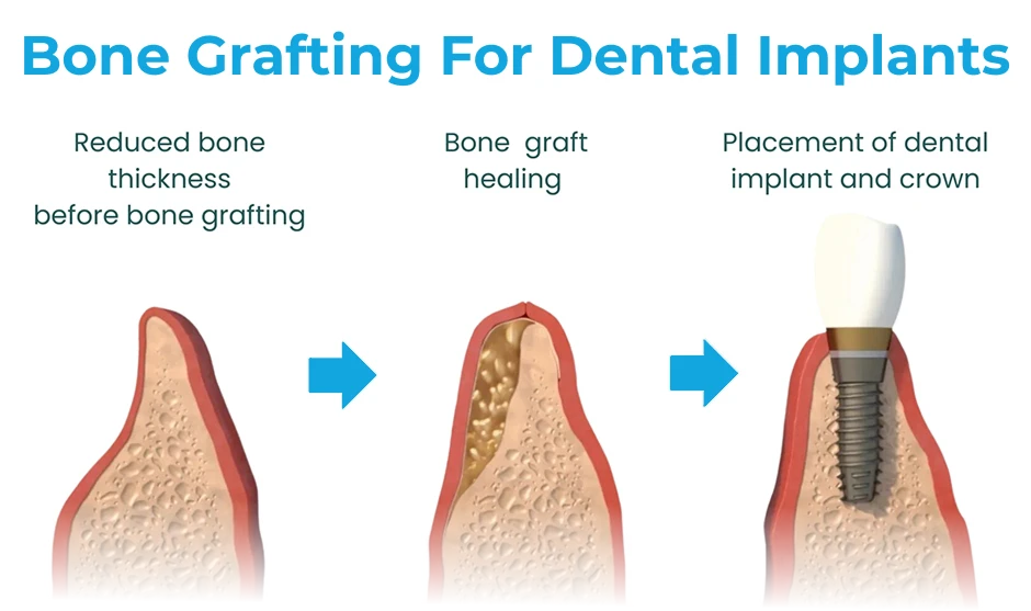 Illustration showing the purpose of a dental bone graft for a single implant