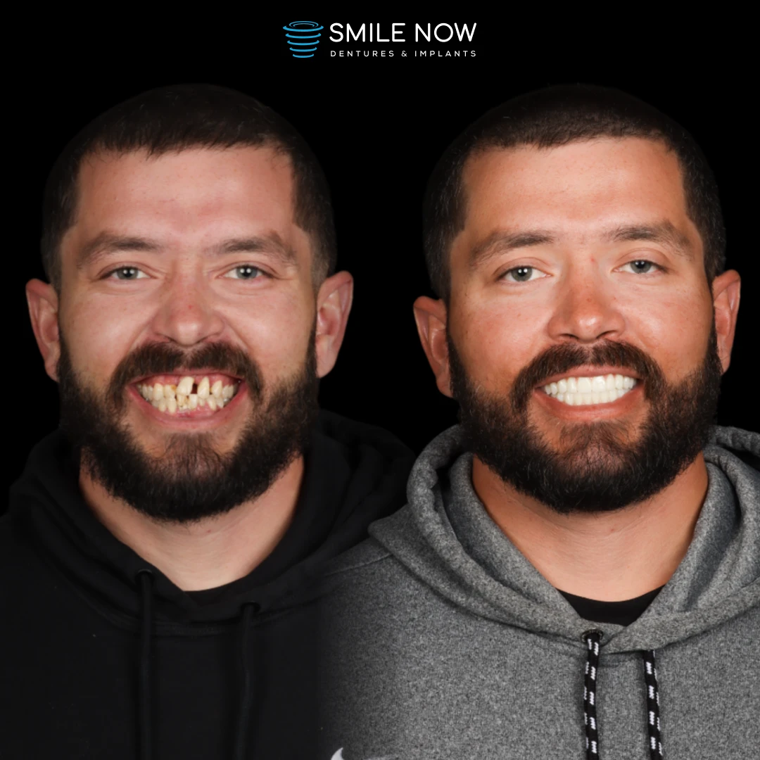 Patient smiling after a smooth dental implant recovery