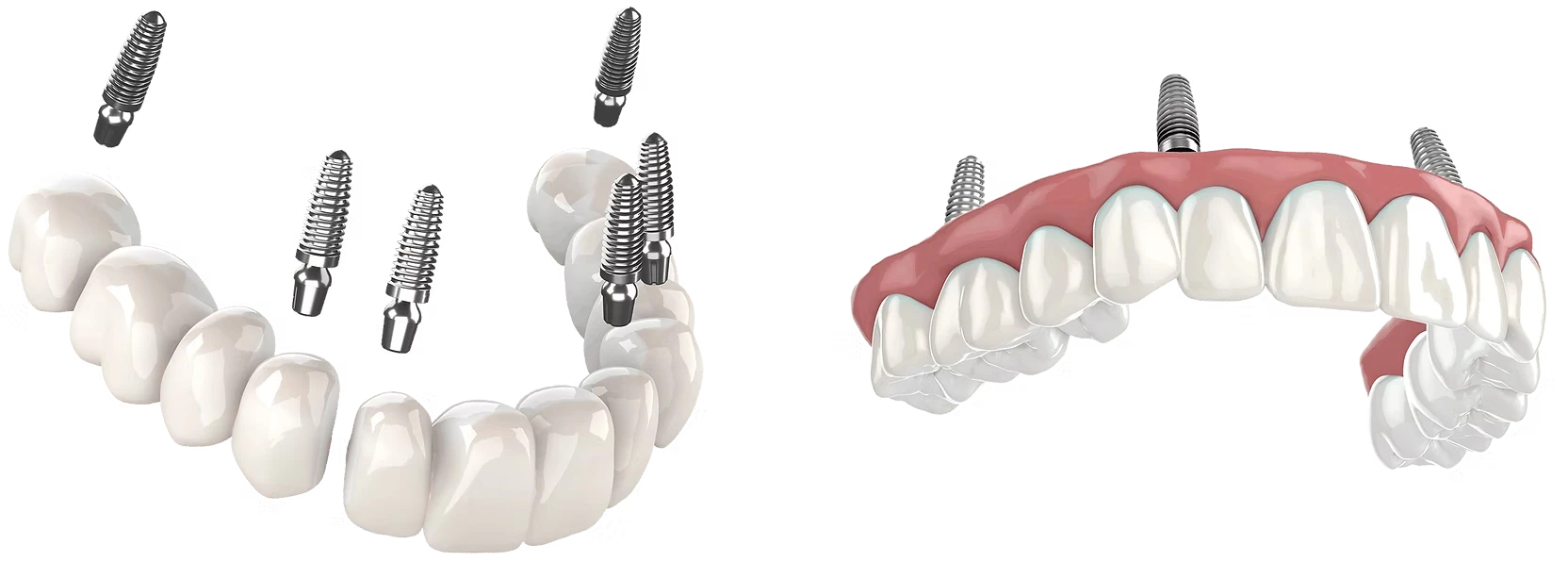 Image comparison showing the difference between 3-On-6 vs All-On-4 dental implants
