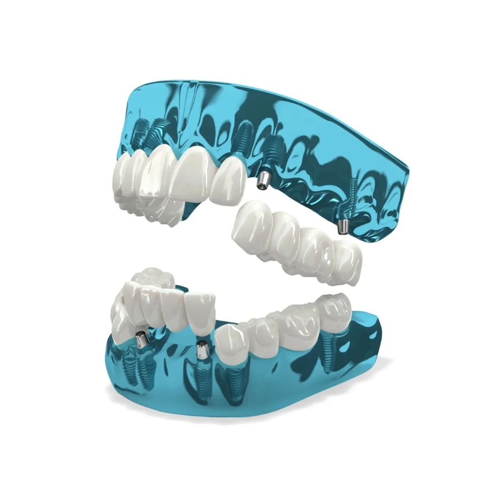 3-on-6 dental implants model