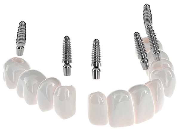 Model showing how 3-on-6 dental implants work